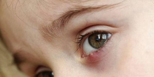 Mudah Dilakukan, Ini 5 Cara Hilangkan Bintitan di Mata