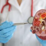 Inilah Ciri-ciri Penyakit Batu Ginjal yang Perlu Diwaspadai