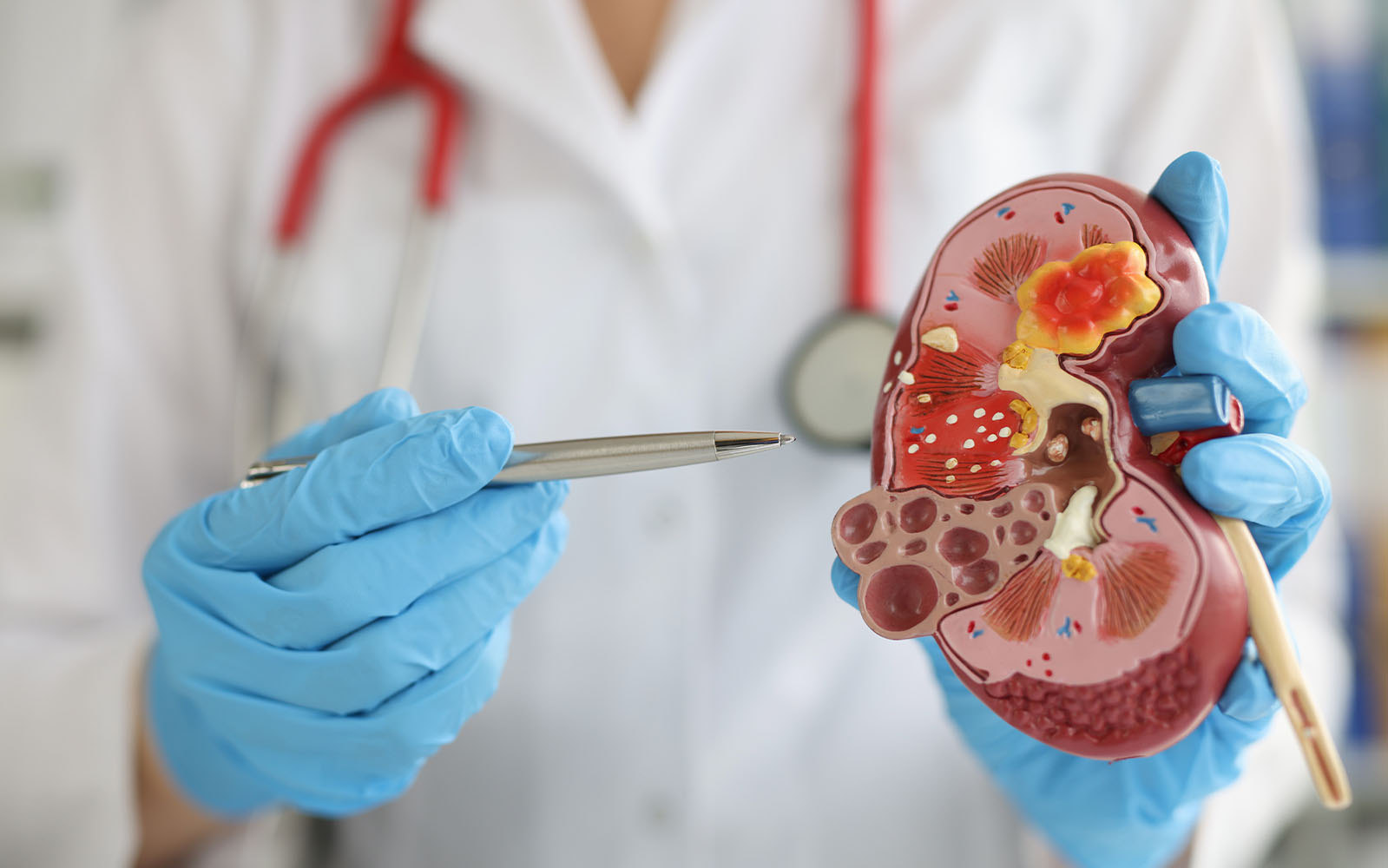 Inilah Ciri-ciri Penyakit Batu Ginjal yang Perlu Diwaspadai