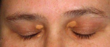 Inilah Tanda Kolesterol Tinggi yang Muncul di Mata, Coba Perhatikan!