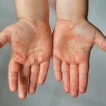 Gejala Campak Sangat Menular, Satu Orang Bisa Tulari 18 Orang