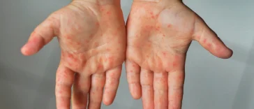 Gejala Campak Sangat Menular, Satu Orang Bisa Tulari 18 Orang