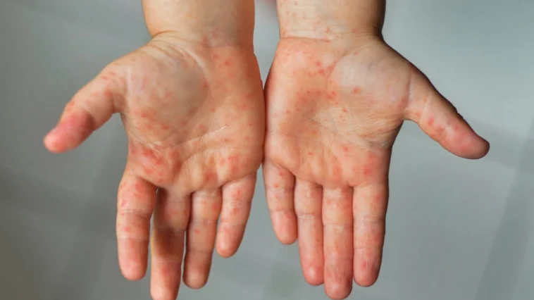 Gejala Campak Sangat Menular, Satu Orang Bisa Tulari 18 Orang