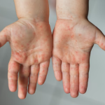 Sekilas Serupa, Kenali 3 Perbedaan Campak dan Cacar Air