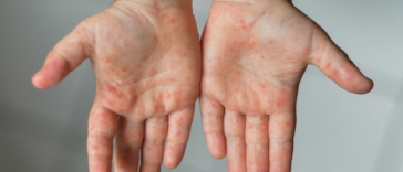 Sekilas Serupa, Kenali 3 Perbedaan Campak dan Cacar Air