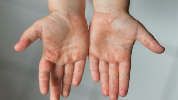 Sekilas Serupa, Kenali 3 Perbedaan Campak dan Cacar Air