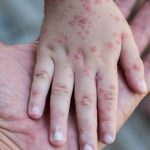 Kasus Campak Tinggi di Indonesia, Seberapa Mudah Virus Ini Menular?