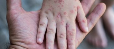 Kasus Campak Tinggi di Indonesia, Seberapa Mudah Virus Ini Menular?