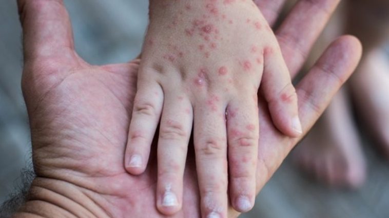 Kasus Campak Tinggi di Indonesia, Seberapa Mudah Virus Ini Menular?