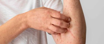 6 Ciri-Ciri Campak pada Orang Dewasa, Ini Gejala yang Umum Terjadi